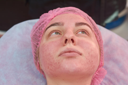 The Ultimate Guide to Peeling for Face: Benefits and Best Options