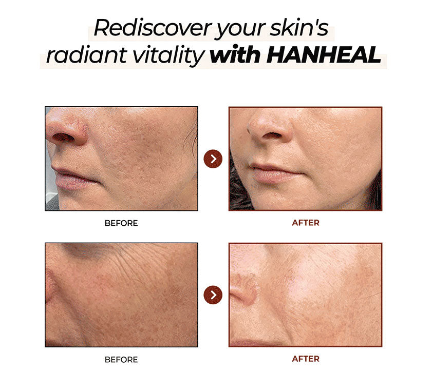 Facial Rejuvenation - fine lines, wrinkles and age spots, improving excess weight and skin smoothing, pore care
