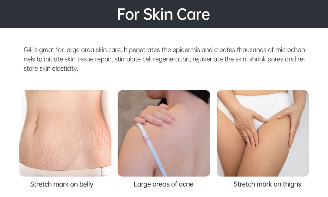 Bio Roller® G4 – Advanced Microneedling Derma Roller, fine lines, enlarged pores, uneven skin texture & thinning hair