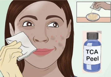 Revitalizing TCA Skin Peel - 10%
